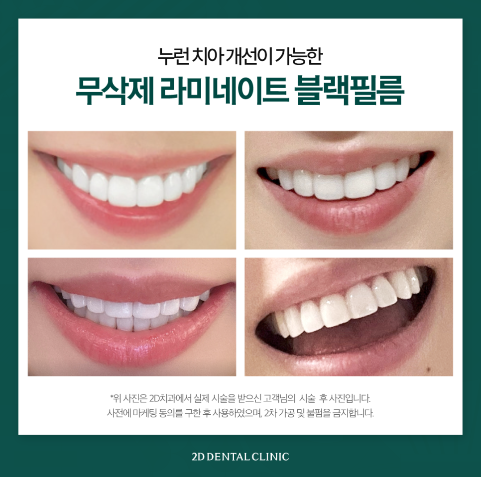 인천무삭제라미네이트 앞니치아변색 커피 먹고 누런 이 다시 하얗게 관련 이미지 6