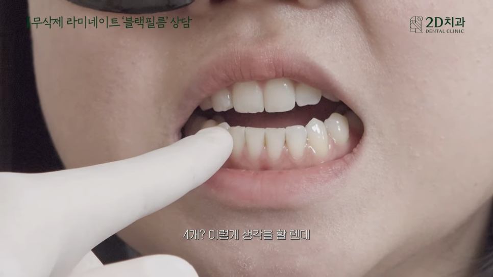 [블랙필름 상담받고 왔어요] #3 앞니가 깨졌어요 관련 이미지 20