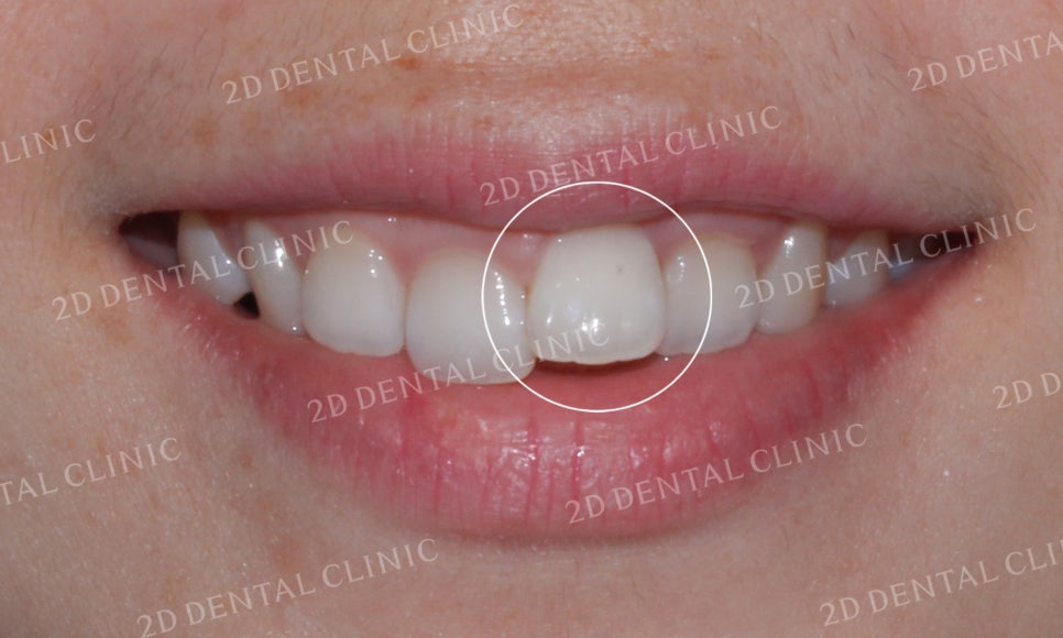[투디교정] 덧니교정, 앞니교정으로 치열을 고르게! by.투디치과(2D치과) 관련 이미지 3