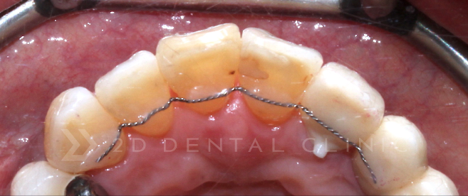 블랙트라이앵글 치아사이틈 개선은 무삭제라미네이트 블랙필름 관련 이미지 4
