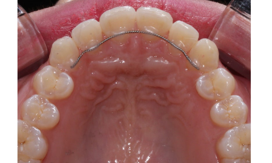 반포치과 뻐드렁니교정 방법은? 관련 이미지 11