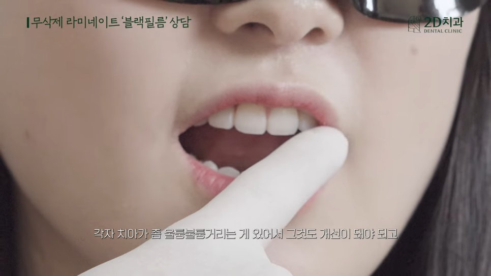 [블랙필름 상담받고 왔어요] #1 큰 앞니 작게 만들 수 있나요? 관련 이미지 21