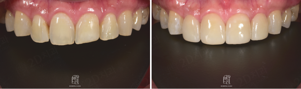 강남라미네이트치과 추천 : 진짜 무삭제, 투디치과! 관련 이미지 15