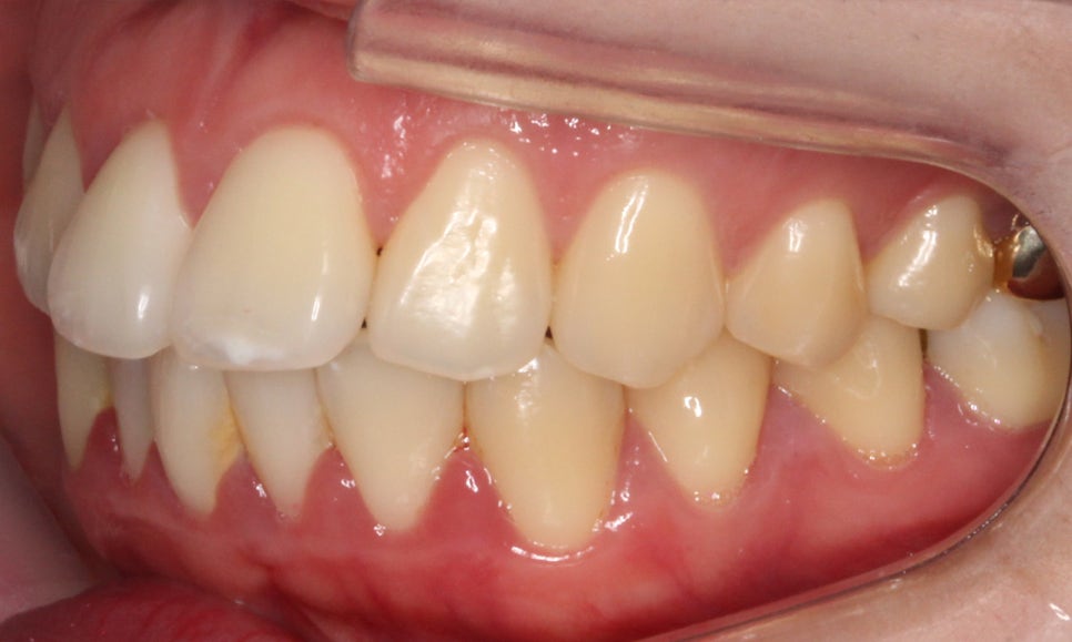 입툭튀 교정 신논현역치과 전체교정으로 관련 이미지 5