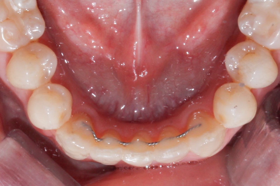 나비치아 교정 케이스 전후비교, 교정전문 2D치과 관련 이미지 10