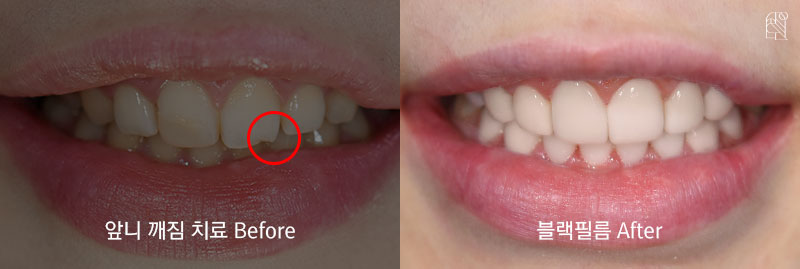 앞니가 깨졌을 때 치료방법은? 관련 이미지 8