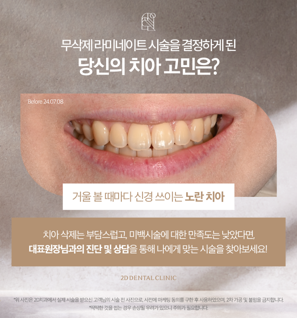 치아화이트닝 하얀이로 거듭날 수 있었던 투디 고객님의 고민은? 관련 이미지 3