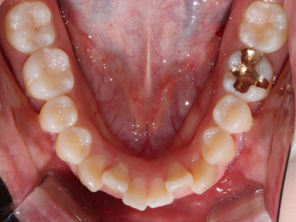 돌출입 탈출기! 덧니 교정도 문제없어! by.투디치과(2D치과) 관련 이미지 9