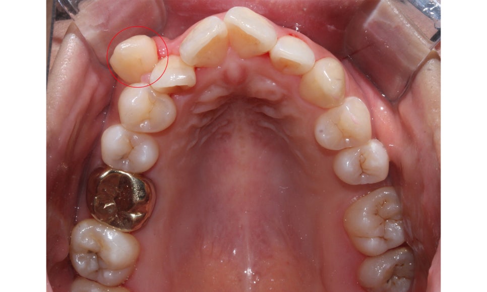 crowding 송곳니덧니 세라믹교정 방법 관련 이미지 7