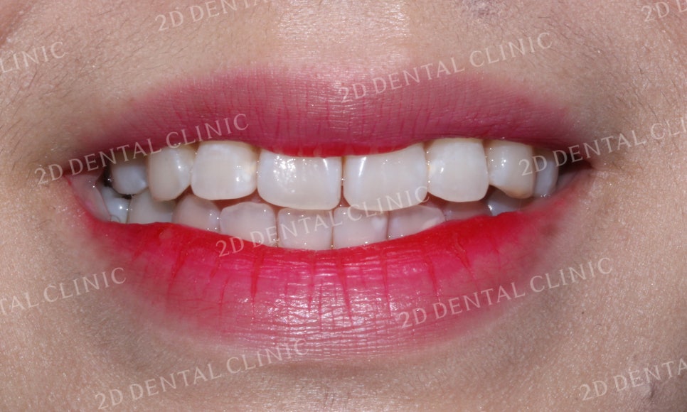 [앞니교정] 부정교합 교정, 앞니교정으로 부정교합 교정하는 방법! by. 투디치과(2D치과) 관련 이미지 10