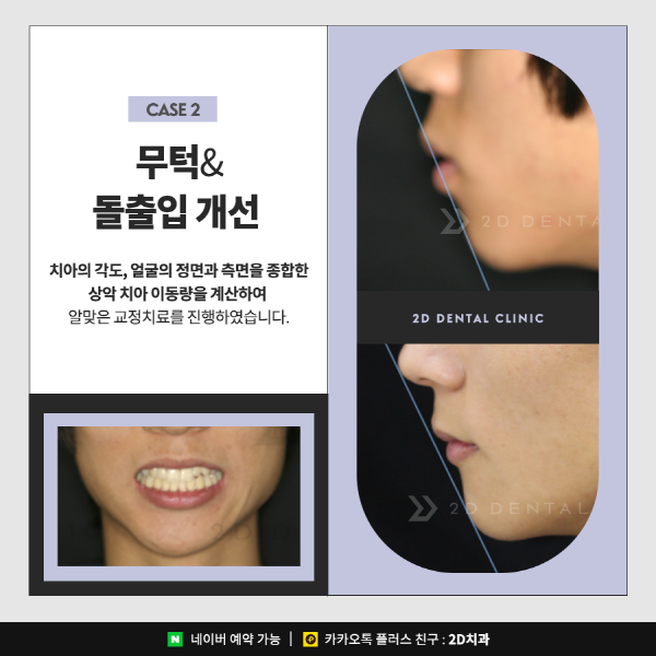 앞니치아교정, 2D교정은 관련 이미지 6