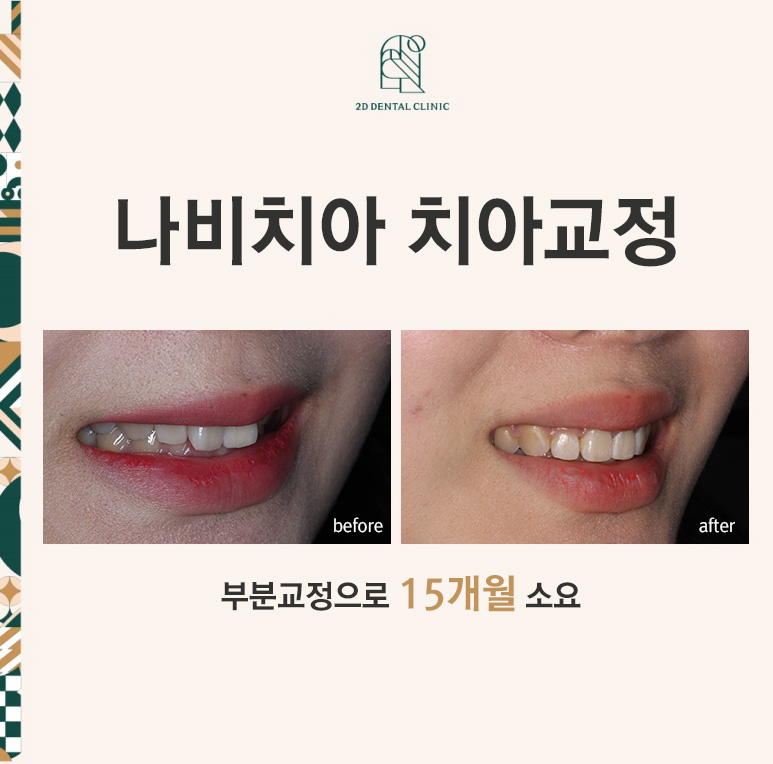 나비치아교정, 부분 치아교정으로 하고 싶다면? by.투디치과(2D치과) 관련 이미지 1