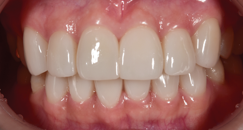 치아 블랙트라이앵글 원인, 예방, 치료 무삭제라미네이트 관련 이미지 10