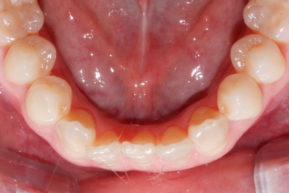 나비치아 교정 케이스 전후비교, 교정전문 2D치과 관련 이미지 9