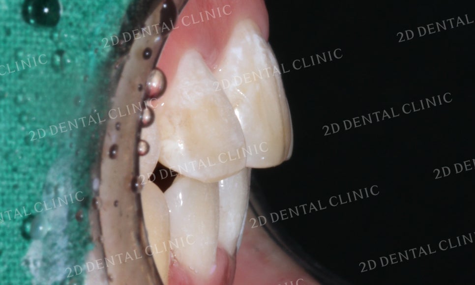 돌출앞니 교정, 튀어나온 입을 넣어보자! by.투디치과(2D치과) 관련 이미지 21