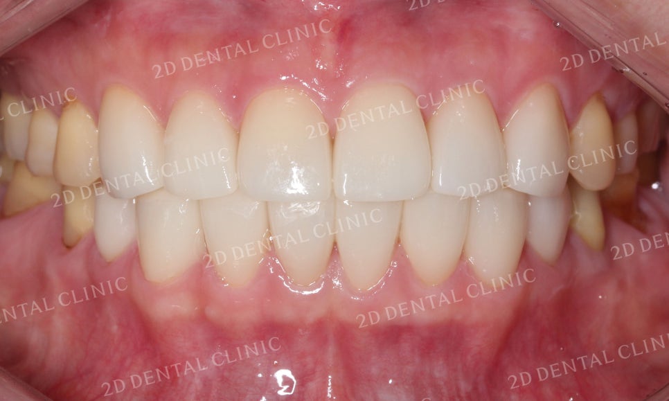 누렇고 손상된 치아를 밝고 가지런하게! by. 투디치과(2D치과)_블링스 시술후기 관련 이미지 6