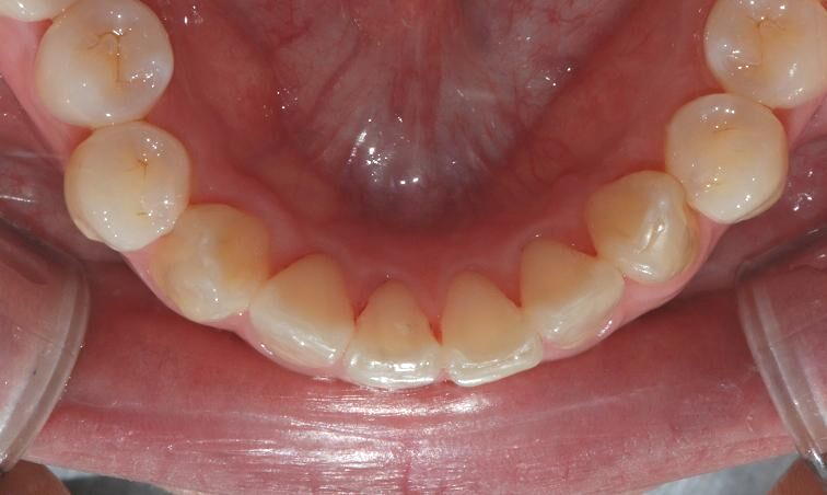 강남역치과[투디치과]투명교정/급속교정 관련 이미지 5