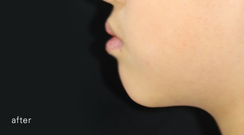 어린이 반대교합 덧니 교정으로 교정 끝! by. 투디치과(2D치과) 관련 이미지 17