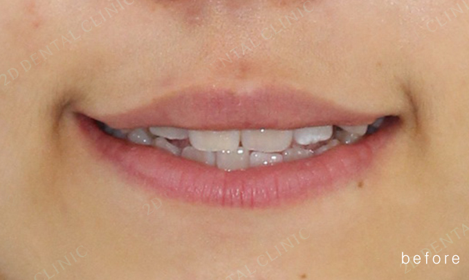 우디의 교정 일기ㅣ부정 교합 치아교정 후기 관련 이미지 12