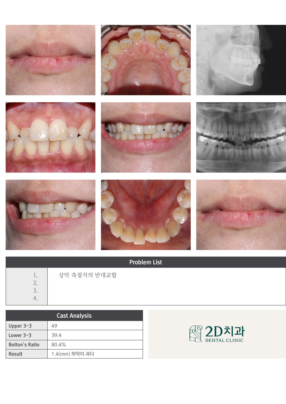 반대교합으로 물리는 치아를 바른 교합으로 교정하기! by.투디치과(2D치과) 관련 이미지 7