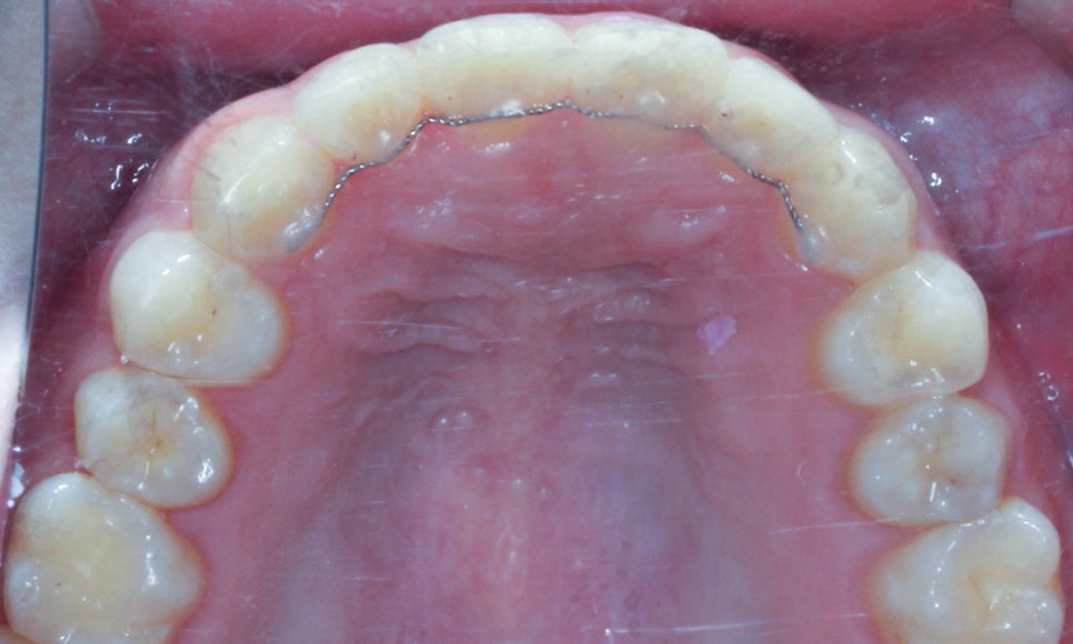 나비치아교정! 15개월만에 빠른 교정 by.투디치과(2D치과) 관련 이미지 13