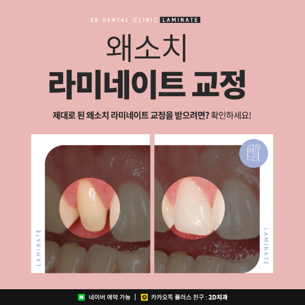 유난히 작은 치아 개선은? 2D 왜소치 라미네이트 교정 관련 이미지 1
