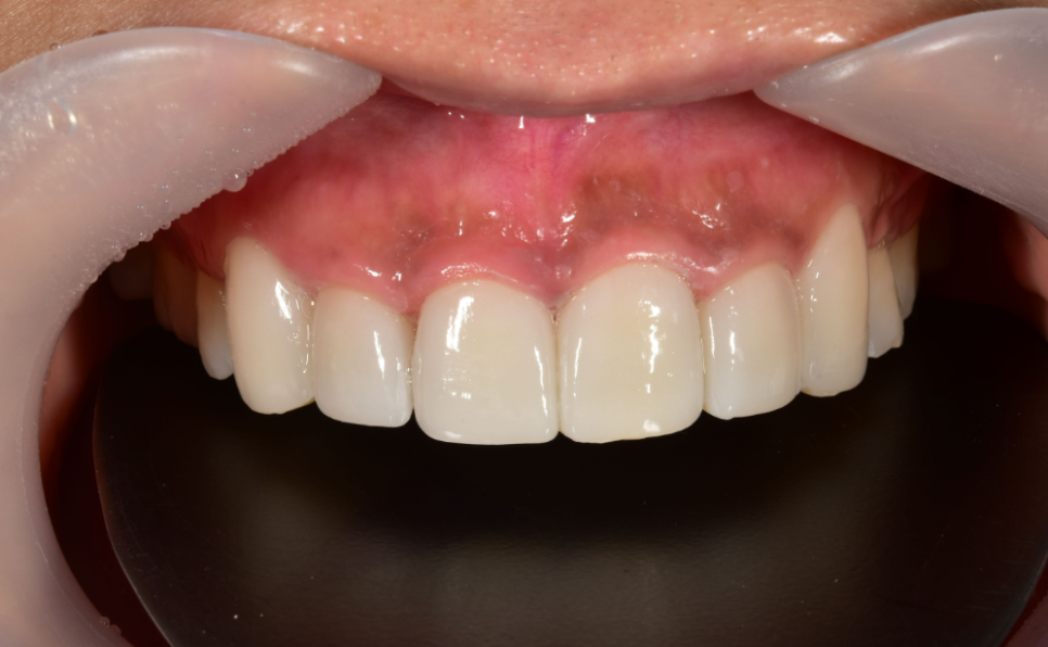 앞니깨짐 라미네이트로 자연스럽게! 관련 이미지 4