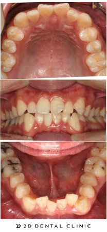 비발치교정, 발치 없이 교정하기! 강남 2D치과 관련 이미지 6