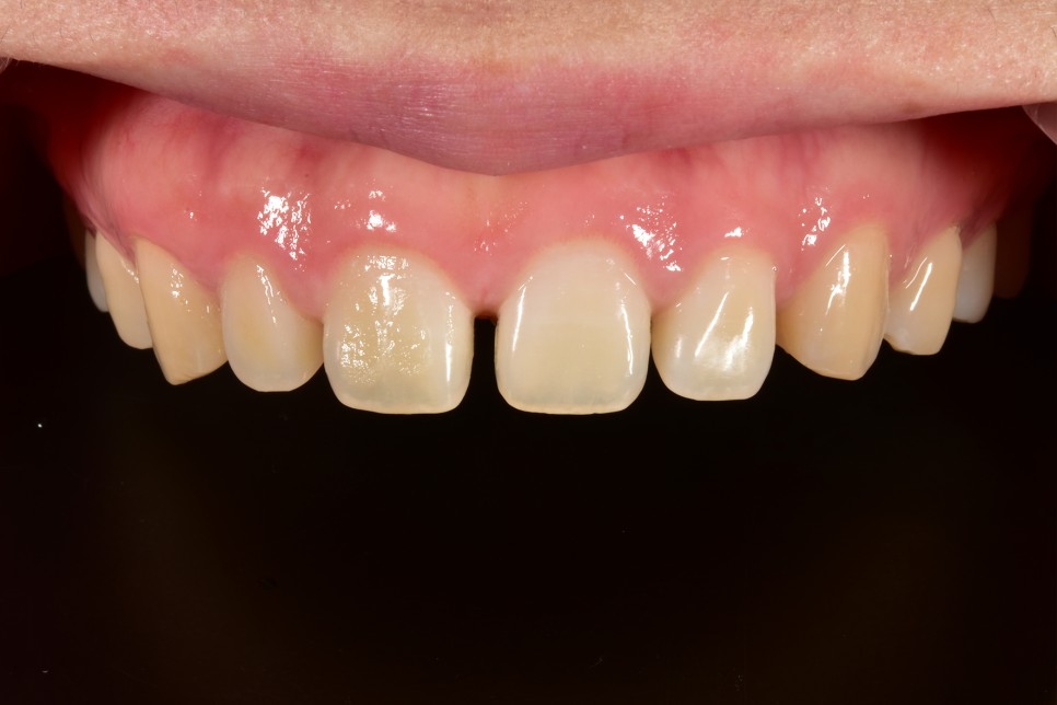 [투디치과] 블랙필름(비스포크) 치료의 다양한 사례 관련 이미지 16