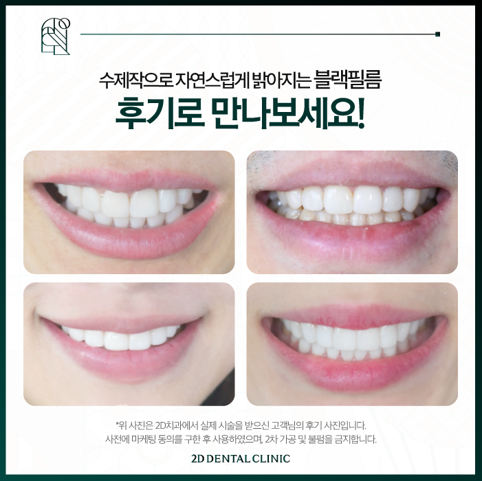 무삭제라미네이트부작용 가격 확인해 보자! 관련 이미지 6