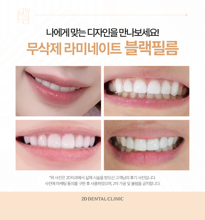 무삭제라미네이트비용 부담은 줄이면서 아름다운 치아로 관련 이미지 8