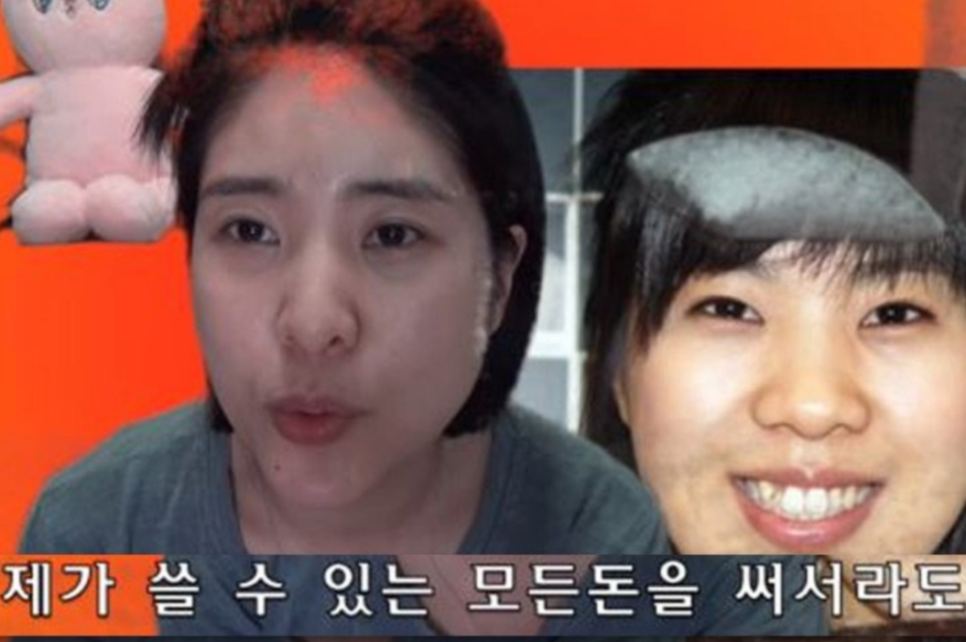 연예인라미네이트 치아삭제단점 보완한 치아삭제 없는 블랙필름 관련 이미지 6