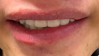 무삭제 라미네이트후기 살펴보기 관련 이미지 1