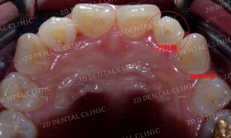 나비치아교정, 부분교정으로 나비치아 탈출하기! by.투디치과(2D치과) 관련 이미지 6