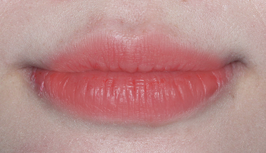 덧니치아 2D교정으로 4개월만에 교정 끝! by.투디치과(2D치과) 관련 이미지 14