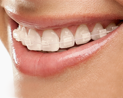 극강심미성추구[투디치과]화이트와이어(white wire) 관련 이미지 3