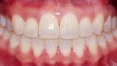 6개월 부분교정. 더이상 망설이지 마세요! 관련 이미지 3