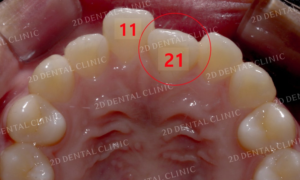 반대교합 치아교정, 앞니를 가지런하게! by.투디치과(2D치과) 관련 이미지 15