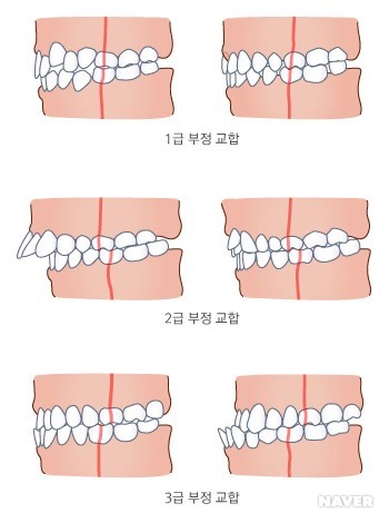 [교정상식] 부정교합 종류! 나는 어떤 케이스에 해당될까? 관련 이미지 3