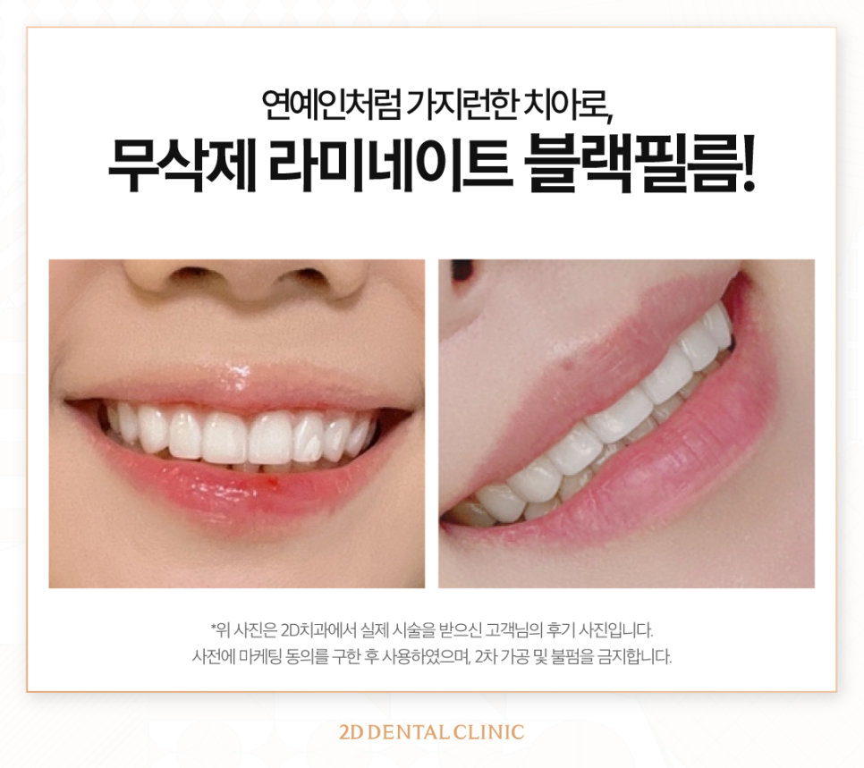 치아무삭제라미네이트 치아성형 연예인처럼 가지런한 앞니 관련 이미지 6