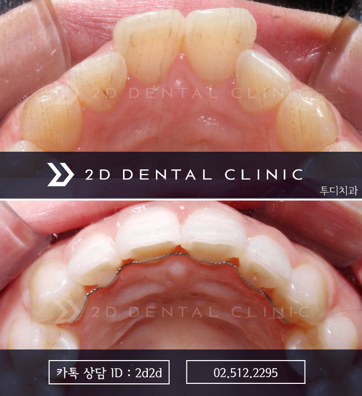 앞니 부분교정, 나의 경우에도 가능할까? 전후 사진 비교 관련 이미지 3