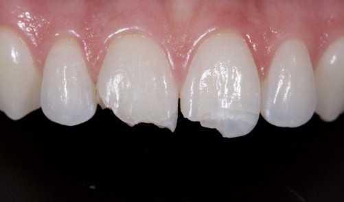앞니깨짐 앞치아치료는 무삭제라미네이트 블랙필름 관련 이미지 4
