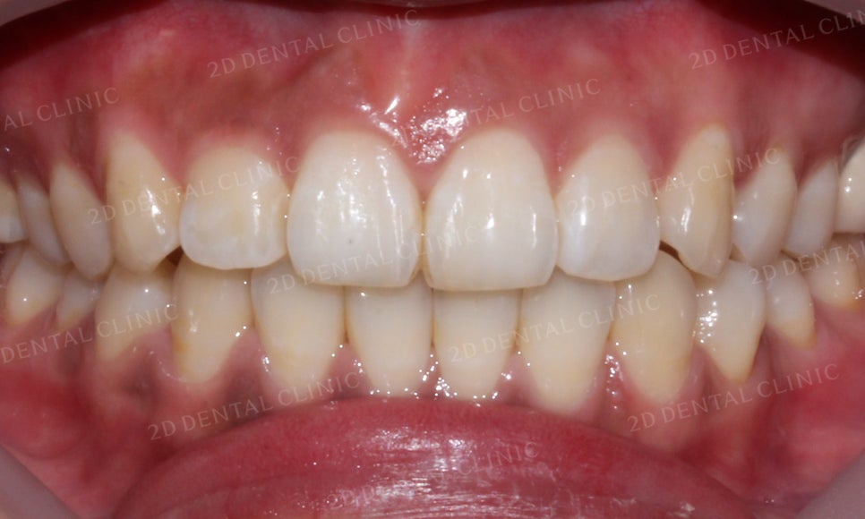 [2D교정] 나비치아, 앞니교정 설측교정으로 빠르게 하는 방법! by.2D치과(투디치과) 관련 이미지 14