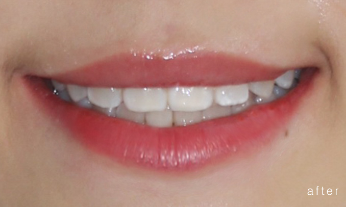 우디의 교정 일기ㅣ부정 교합 치아교정 후기 관련 이미지 13