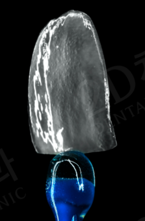 치아변색 고민없는 무삭제라미네이트 블랙필름 관련 이미지 3