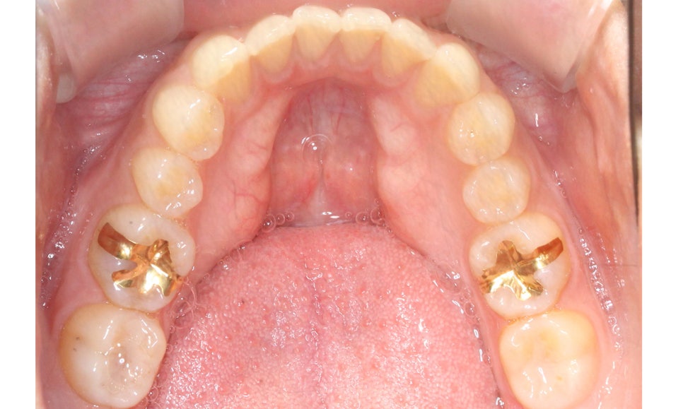 나비앞니 세라믹교정 case 관련 이미지 14