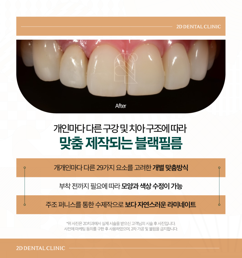 무삭제라미네이트후기 치아살짝깨짐 그대로 두어도 될까요? 관련 이미지 5