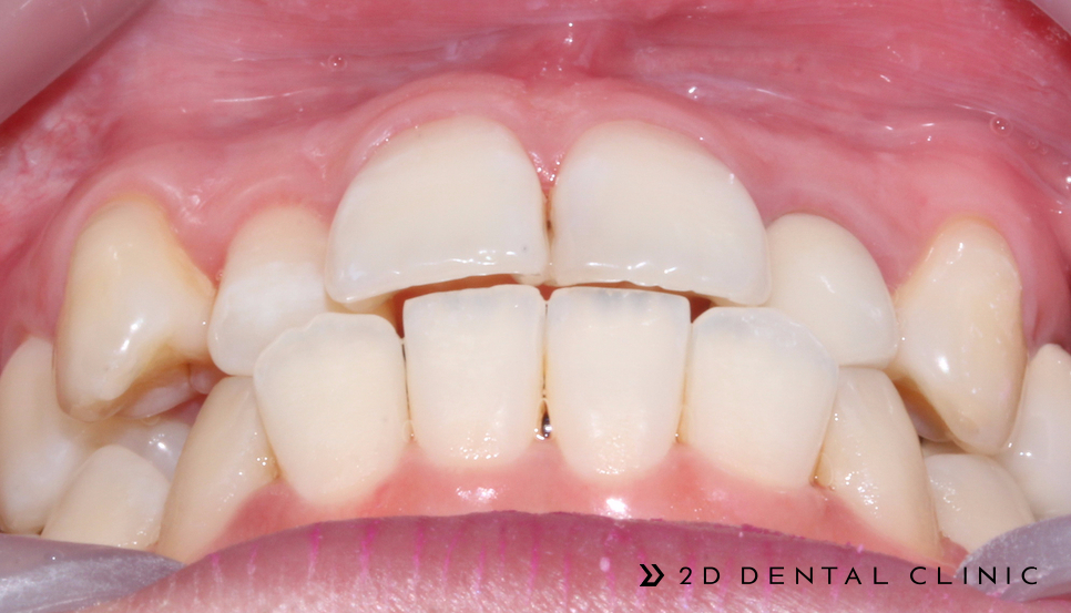 케이스로 확인하는 덧니 부정교합, 교정전문 2D치과 관련 이미지 7