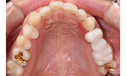 앞니틀어짐 부분교정 완성 후기 관련 이미지 6