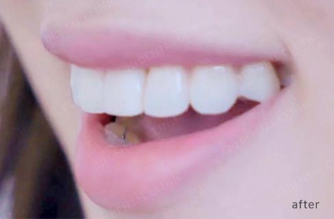 투디치과(2D치과)에서 직!접! 무삭제 쎄라필름을 한 리얼후기 관련 이미지 7